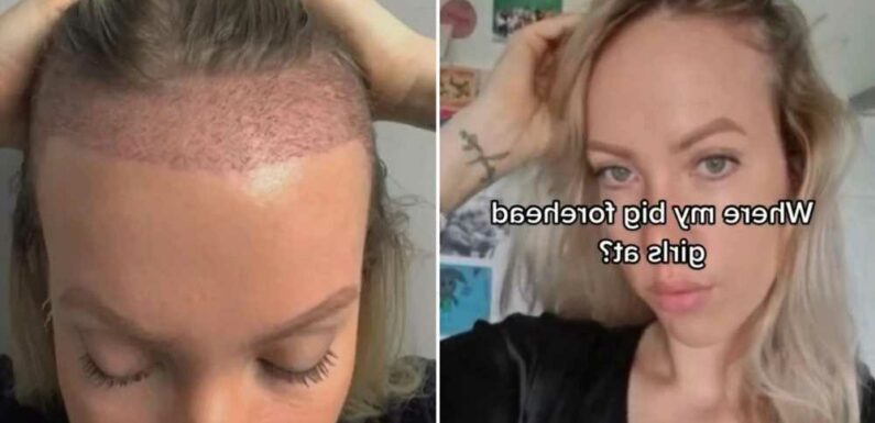 I hated my big forehead so I got a hair transplant to hide it, trolls say I shouldn’t have bothered but I love it | The Sun