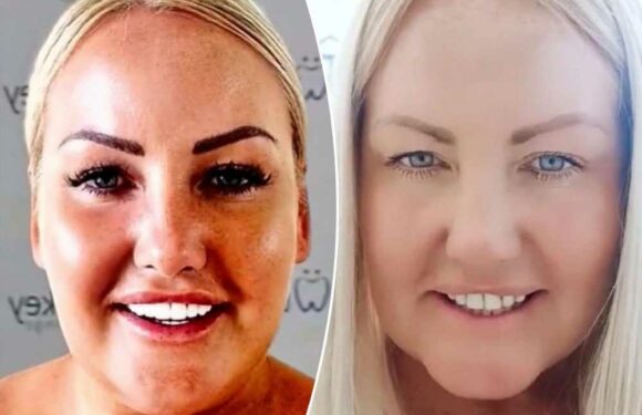 I splashed £4k on Turkey teeth because I wanted a white smile – trolls say I may as well have thrown my money in the bin | The Sun
