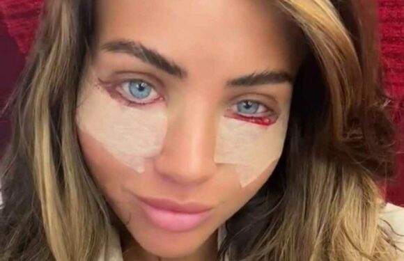 I travelled to have my under eye bags removed for thousands… people say I looked great before but I needed this | The Sun