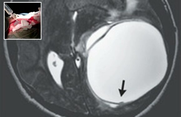 Shocking images show doctors remove cyst the size of a fist from teen’s brain | The Sun