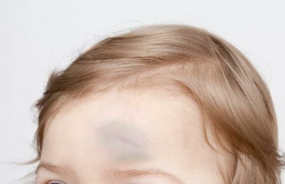 Tiny Hearts Education: How to tell if a child's head bump is serious