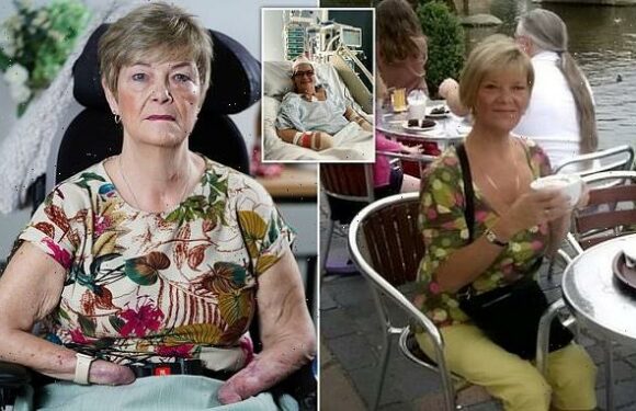 Amputee claims she was asked if she would accept MALE hand transplant