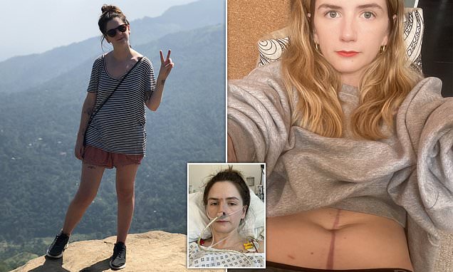 Doctors tried FIVE times to  remove my contraceptive coil