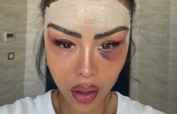 I flew to Turkey for fox eye surgery…I love my new look but trolls say it’s made me look older & think I've wasted money | The Sun