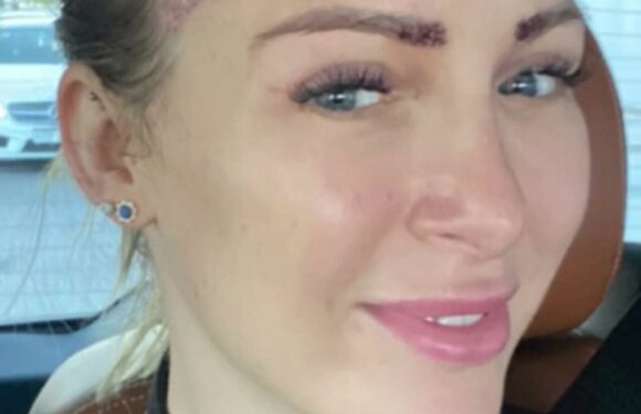 I got a hair transplant in Turkey, I hide it in clever ways – trolls said I shouldn't do this but I'm in the right | The Sun