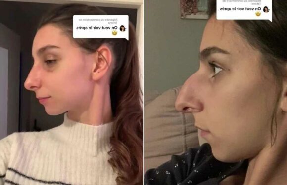 I got surgery to get rid of my crow-shaped nose – I’m happy but trolls say I’ve made it look worse | The Sun