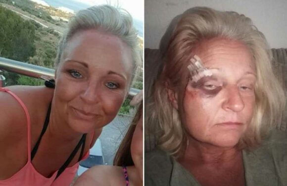 I lost half my face after catching a flesh eating bug – but it’s helped me find love | The Sun