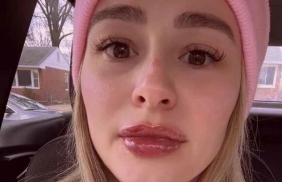 I spent loads on filler & thought I’d lose my lips – no one’s ever seen bruising so bad | The Sun