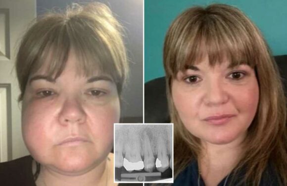 I won £15K after the anaesthetic failed as my dentist pulled my tooth out – I was in floods of tears | The Sun