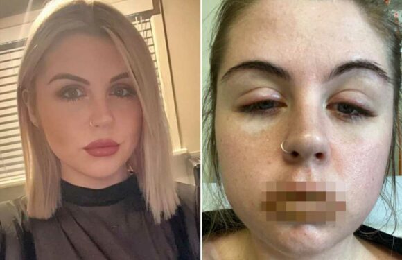 I'm sharing harrowing photos after I was left 'burning from the inside out' so others don't face my horror | The Sun