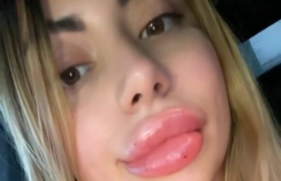 I’ve had loads of lip filler, my pout is so huge – trolls hate them & say I look like a duck but I love the swollen look | The Sun