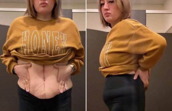 My surgeon talked me into a major tummy tuck surgery & now I'm botched…my belly looks worse & my belly button’s vanished | The Sun