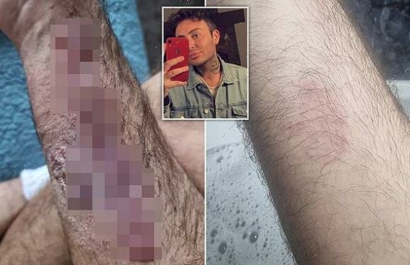 Student fears he 'could have been killed' after hair dye patch test'