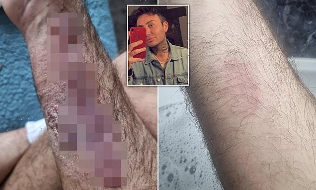 Student fears he 'could have been killed' after hair dye patch test'