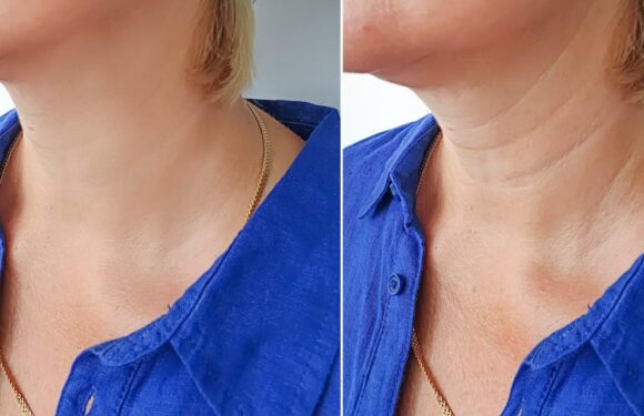 This Neck Tightening Cream Has the Most Incredible Before and After Shots
