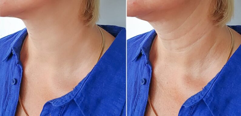 This Neck Tightening Cream Has the Most Incredible Before and After Shots
