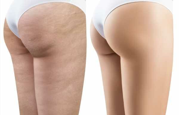 10 Best Butt and Thigh Cellulite Solutions for Real Results