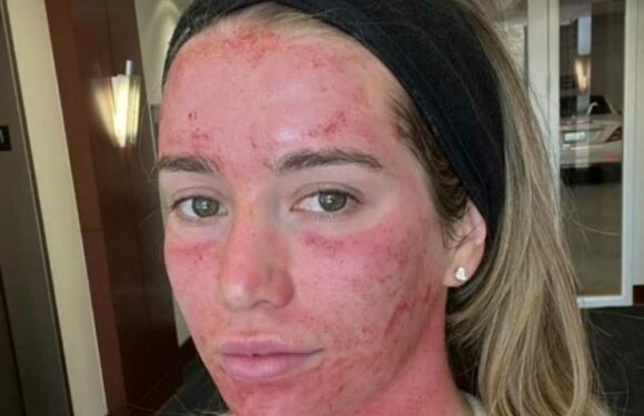 I’ve tried lots of cosmetic surgery, here’s what I love & loathe – I smelt rotting skin after a facial but still rate it | The Sun