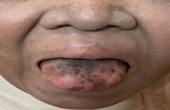 Woman left with black and HAIRY tongue after reaction to common antibiotic | The Sun
