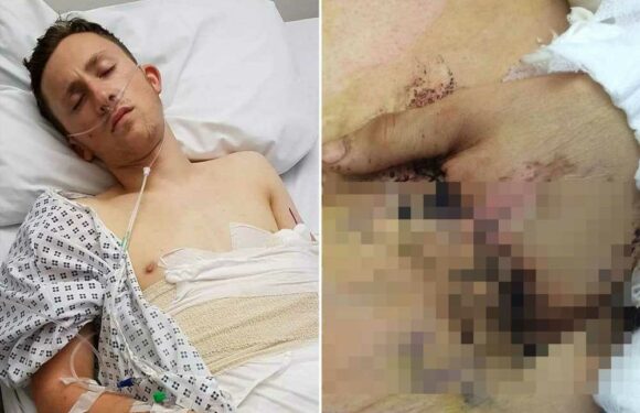 My hand was 'degloved' in an industrial mangle – surgeons saved it using World War I technique | The Sun