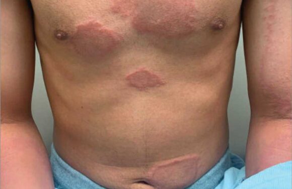 Doctors shocked to discover man's rash was actually a case of killer medieval disease | The Sun