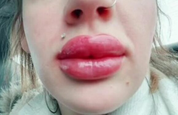 I wanted my lips tattooed a pretty colour but it went wrong…now my pout is so HUGE trolls say I look like a Flappy Bird | The Sun