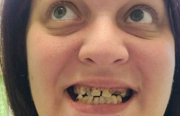 I was a gummy grinner with no teeth & accused of being a catfish – after spending £1.7k on dentures I can smile normally | The Sun