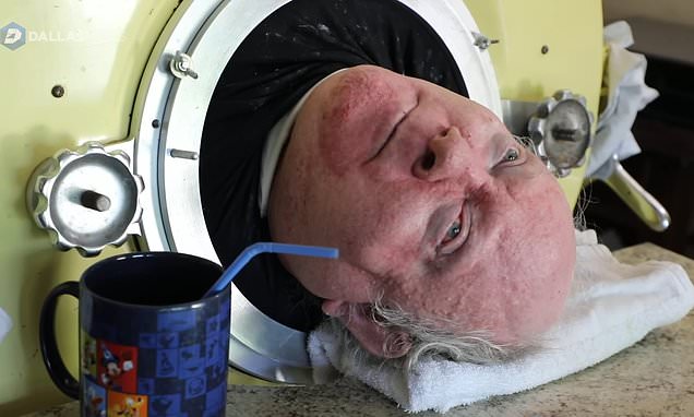 Man lived inside iron lung for 70 years developed new way of breathing