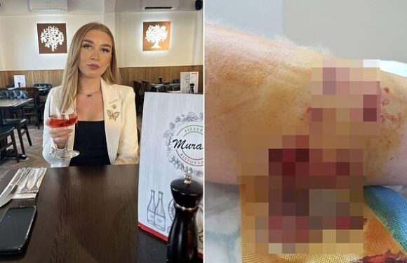 Wounds suffered by girl who had chunks torn from her leg in dog attack