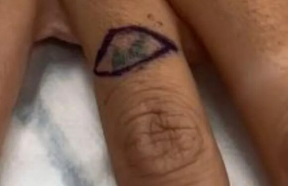 I didn't want to wait to get my tacky ring tattoo lasered so I had it CUT out – people say it’s my own fault | The Sun