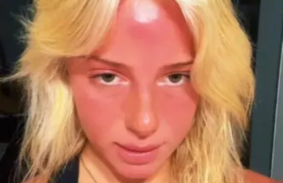 I wanted to be bronzed on holiday so I slathered myself in tanning oil – it was a big mistake, now I look like a tomato | The Sun
