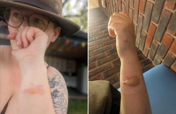 I was left with ‘painful’ blisters despite wearing gloves after brushing against bush – people don't know it's dangerous | The Sun