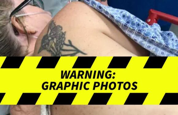 Stingray Impales FL Woman, Gnarly Pics of Venomous Barb Left in Her Back