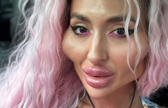 Woman with world’s biggest cheeks takes pics at 18 and 34 to show extreme change