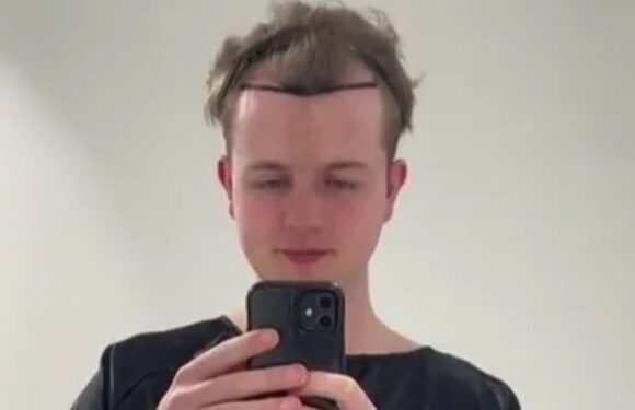 I forked out £4k for a hair transplant in Turkey aged 21 – it was the worst pain I've ever felt but totally worth it | The Sun