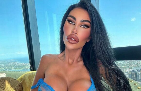 ‘Plastic surgery queen’ has ‘most of filler dissolved’ – but fans spot problem