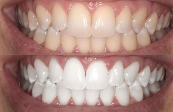 ‘Very effective’ Colgate teeth whitening kit gives ‘clear results’
