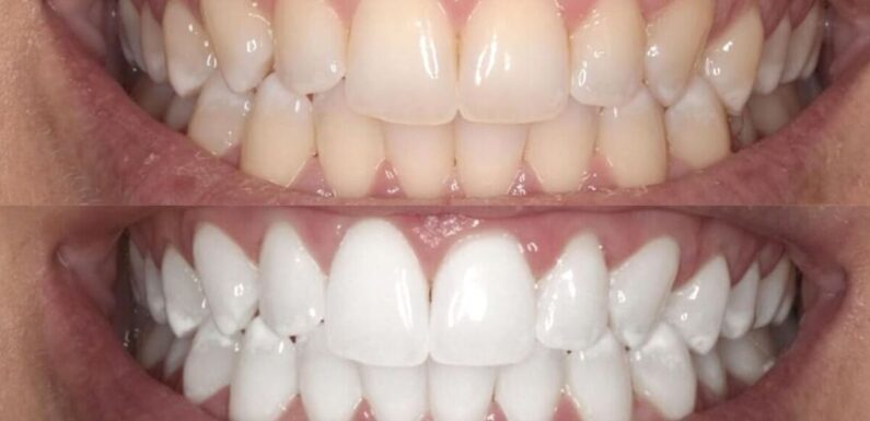 ‘Very effective’ Colgate teeth whitening kit gives ‘clear results’