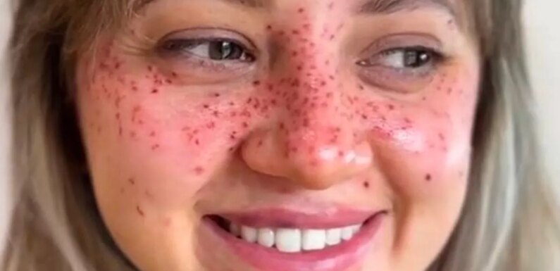 Women transform with freckle tattoos – but those bullied are baffled by ‘trend’