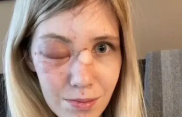 Husband 'caved wife's face in during drug-fuelled frenzy that left her half-blind' | The Sun