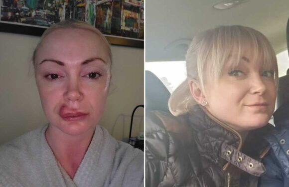 I got £100 lip filler & it derailed my life – my face ended up on fire then exploded, I looked like a monster | The Sun