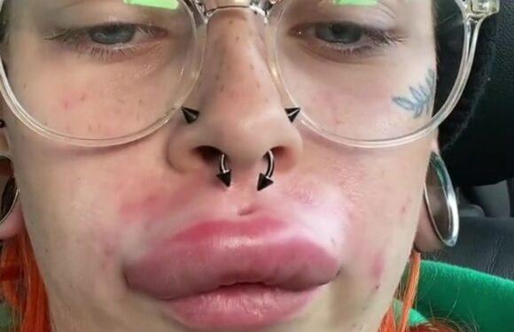 I got my dodgy 'moustache' lip filler dissolved but it was a total fail…it was so painful & my pout is seriously swollen | The Sun