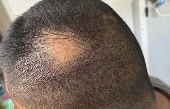 I had a palm-sized bald spot but I've seen results within a day from my $10 Amazon oil, people say it's a 'life-saver' | The Sun
