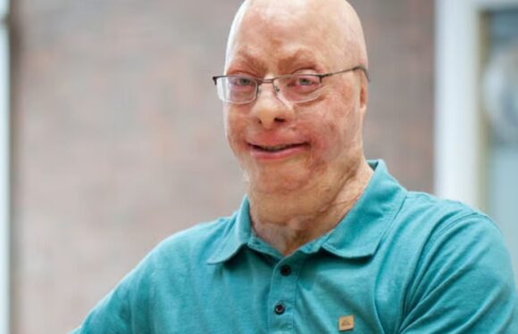 I was a human fireball for 20 seconds and feared I'd burn to death