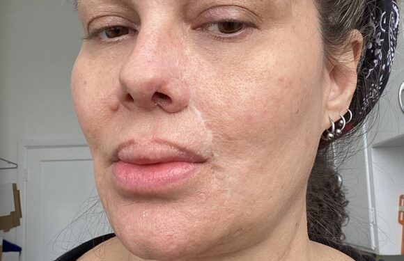 Woman who got filler was horrified when it made her nostril FALL off