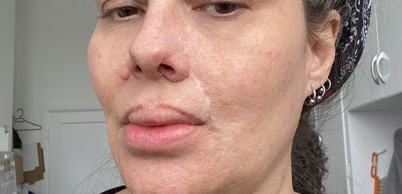 Woman who got filler was horrified when it made her nostril FALL off