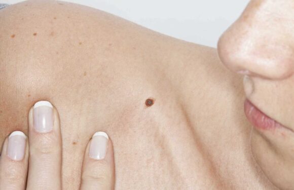 Can you spot the deadly moles from the harmless ones? The skin cancer signs you must never ignore – The Sun | The Sun