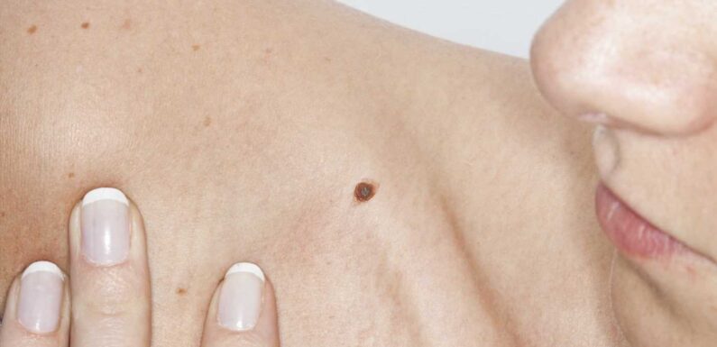 Can you spot the deadly moles from the harmless ones? The skin cancer signs you must never ignore – The Sun | The Sun